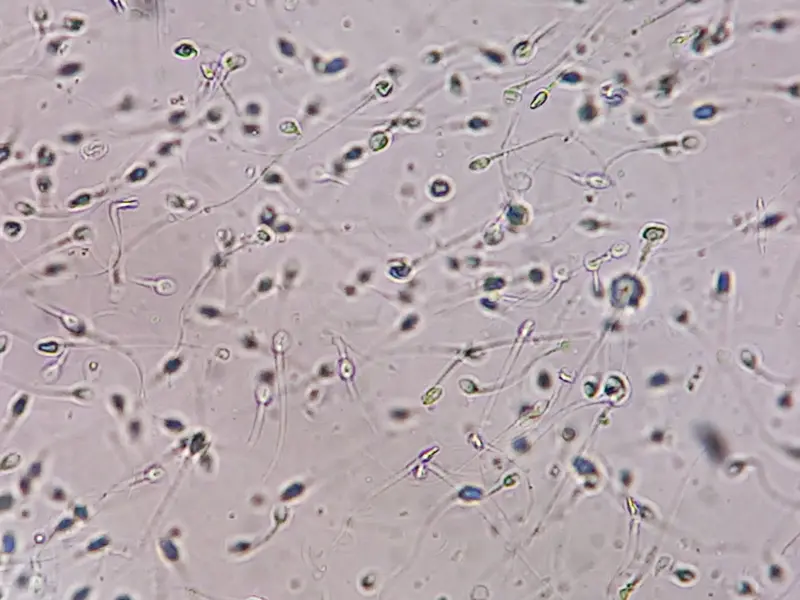 Mientras que en condiciones normales el esperma contiene millones de espermatozoides, en aquellos azoospérmicos casi no se encuentran.